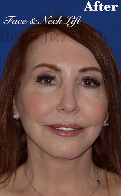 Facelift Before & After Gallery - Patient 153420 - Image 2