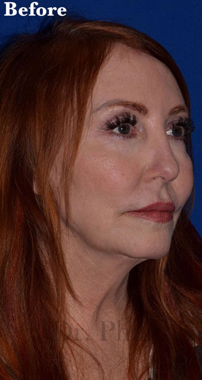 Facelift Before & After Gallery - Patient 153420 - Image 3