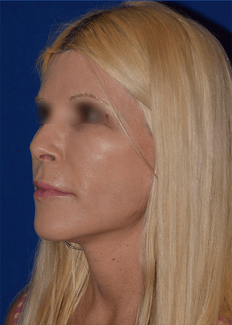 Neck Lift Before & After Gallery - Patient 393416 - Image 4