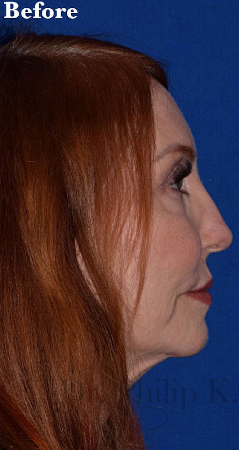 Facelift Before & After Gallery - Patient 153420 - Image 5