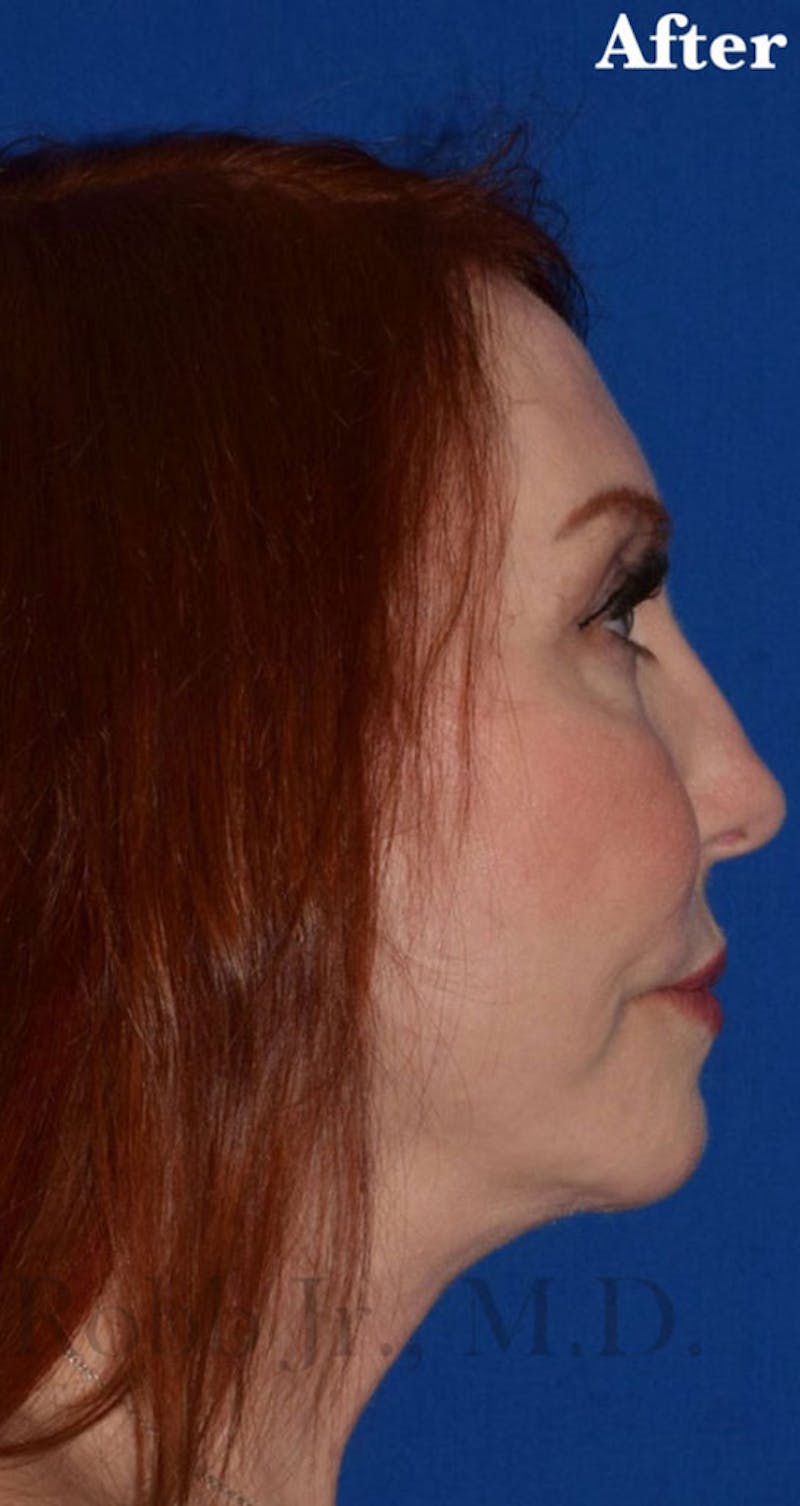 Facelift Before & After Gallery - Patient 153420 - Image 6