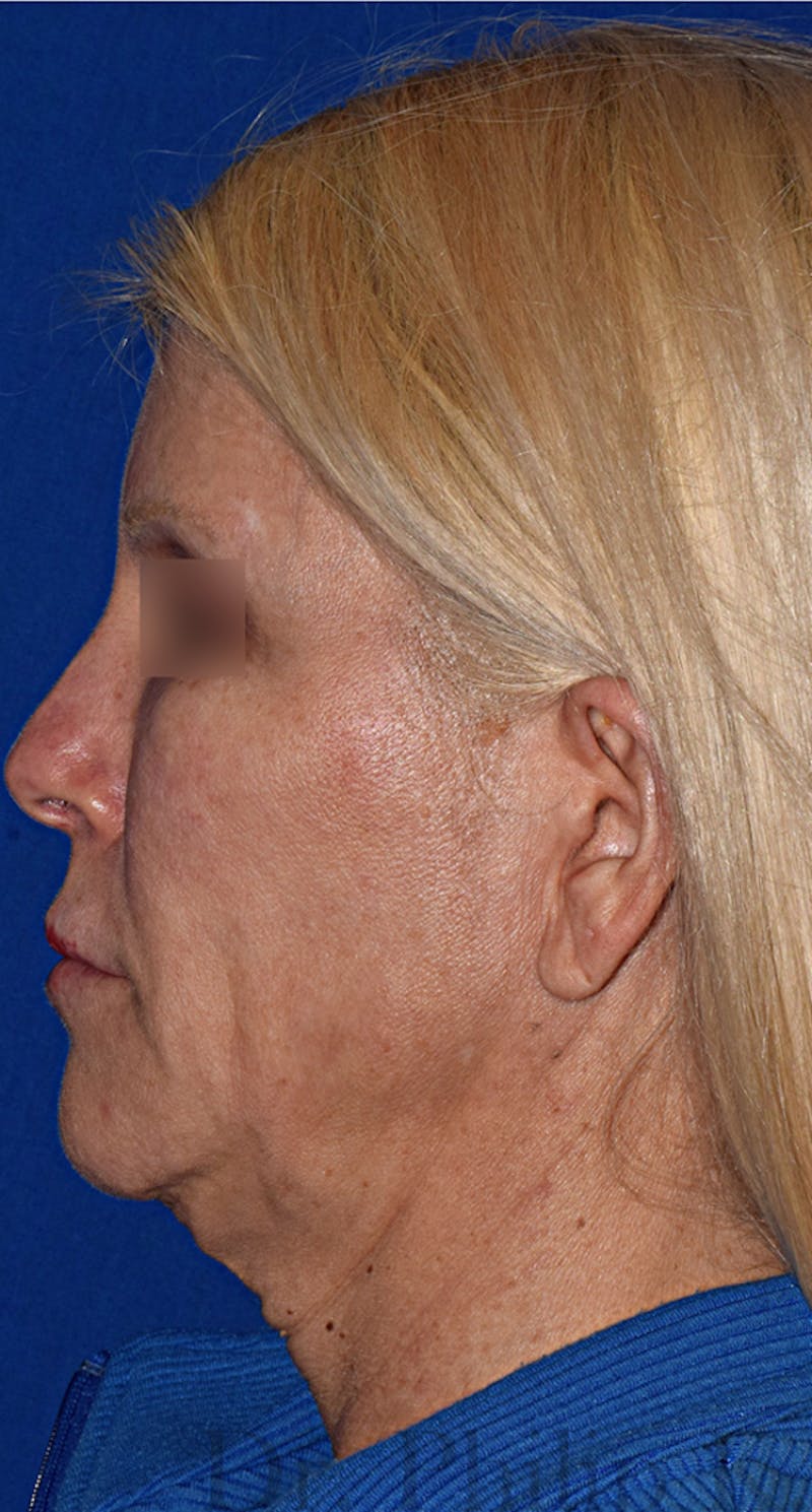 Neck Lift Before & After Gallery - Patient 393416 - Image 5