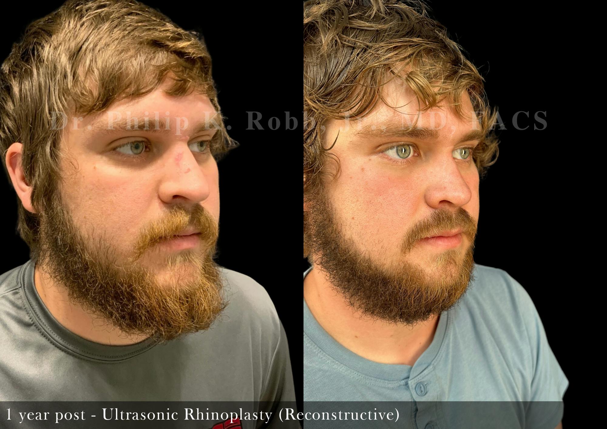 Ultrasonic Rhinoplasty Before & After Gallery - Patient 896389 - Image 5