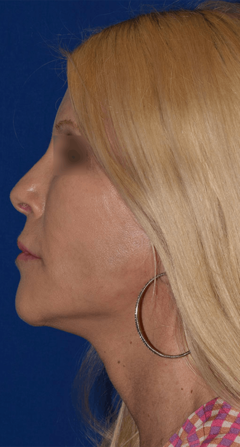 Neck Lift Before & After Gallery - Patient 393416 - Image 6