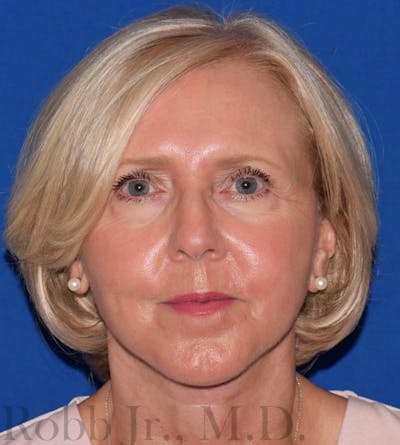 Facelift Before & After Gallery - Patient 733449 - Image 2