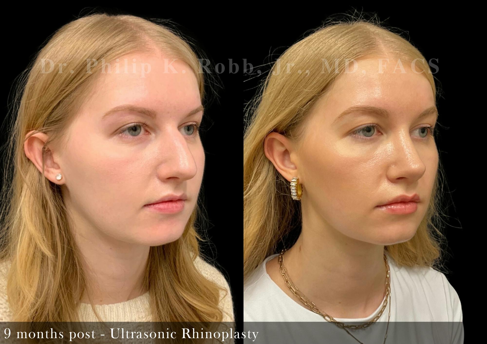 Ultrasonic Rhinoplasty Before & After Gallery - Patient 207178 - Image 2