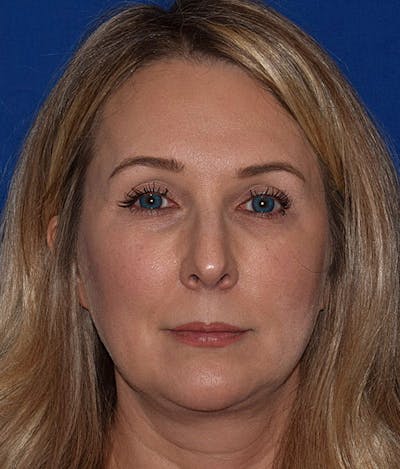 Facelift Before & After Gallery - Patient 427664 - Image 1