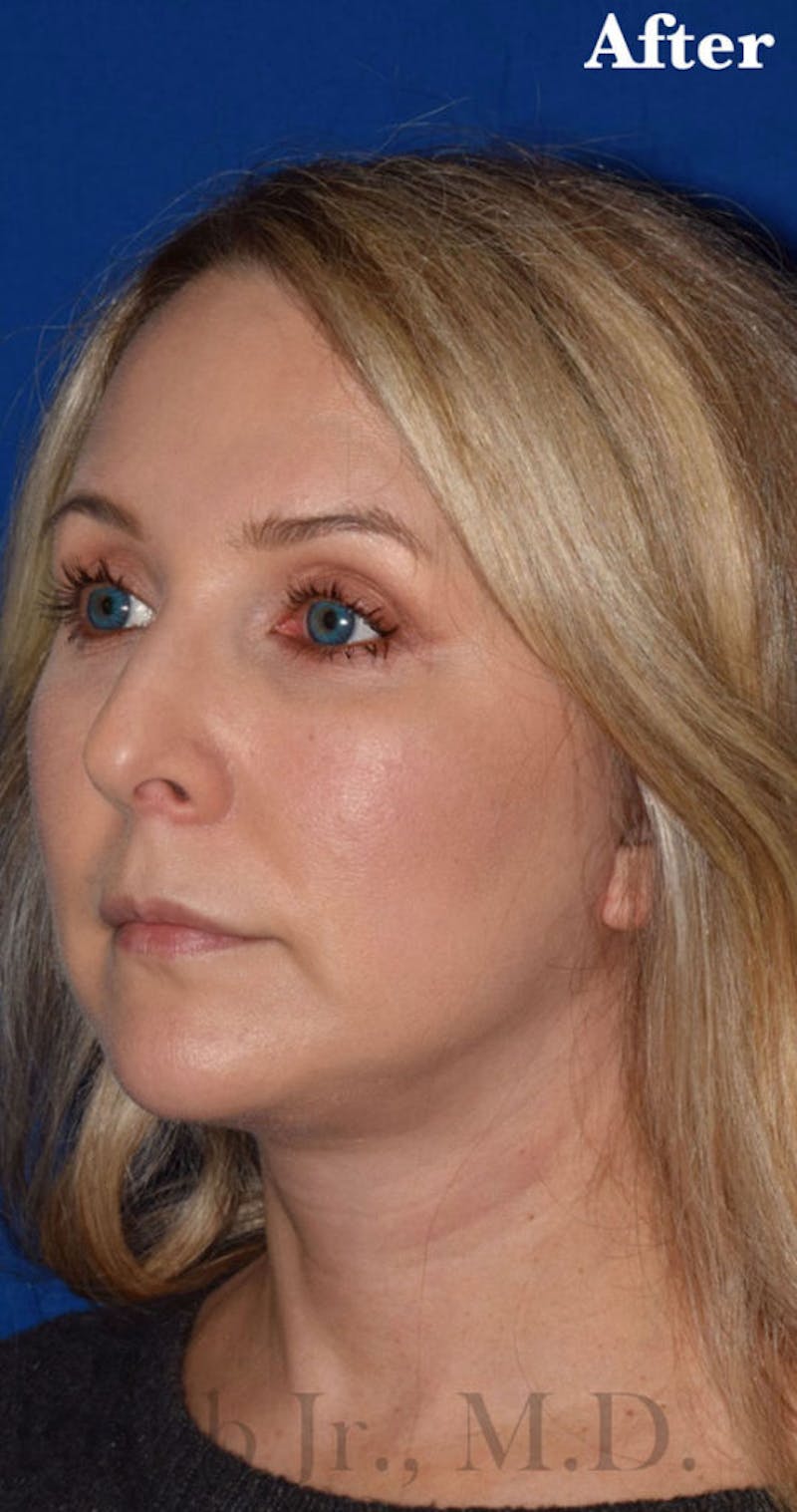 Facelift Before & After Gallery - Patient 427664 - Image 4