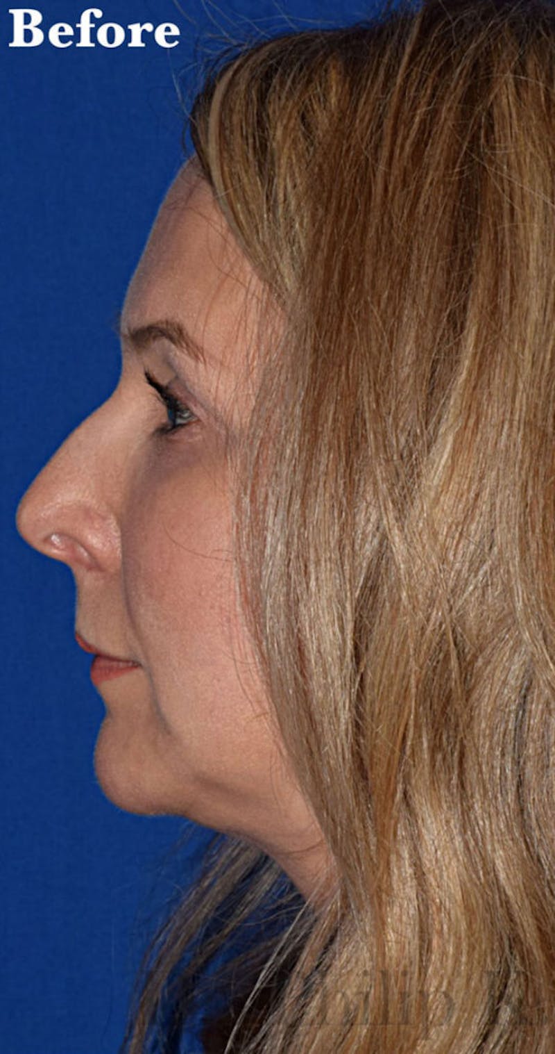 Facelift Before & After Gallery - Patient 427664 - Image 5