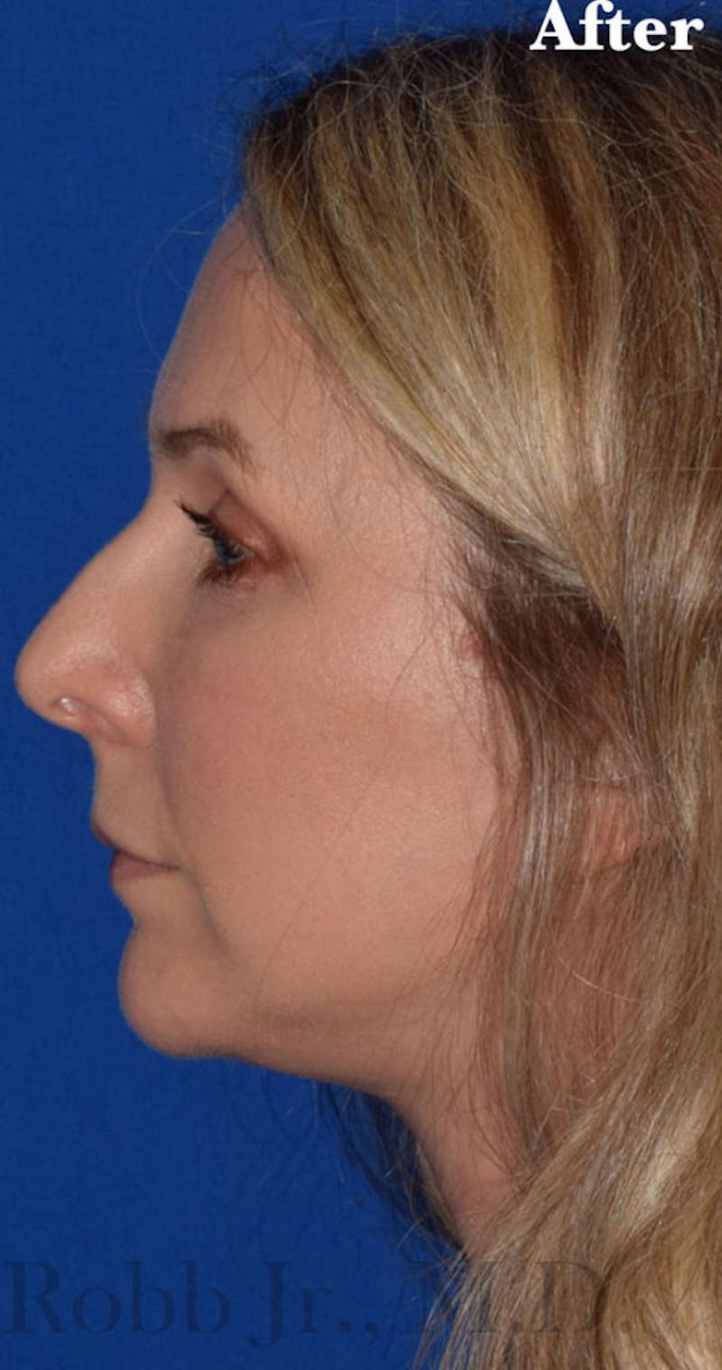 Facelift Before & After Gallery - Patient 427664 - Image 6