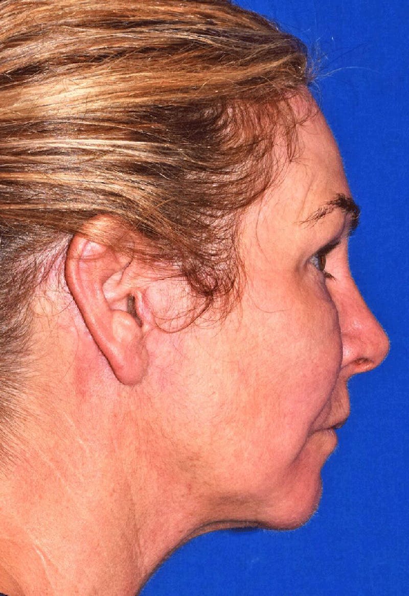 Neck Lift Before & After Gallery - Patient 605324 - Image 2