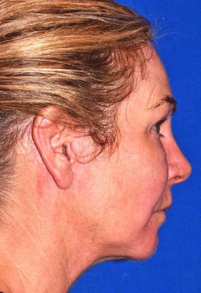 Neck Lift Before & After Gallery - Patient 605324 - Image 2