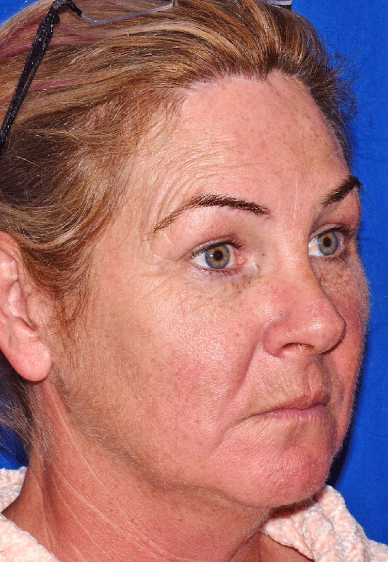 Neck Lift Before & After Gallery - Patient 605324 - Image 3