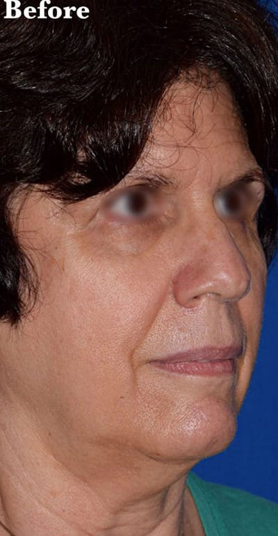 Facelift Before & After Gallery - Patient 175505 - Image 1