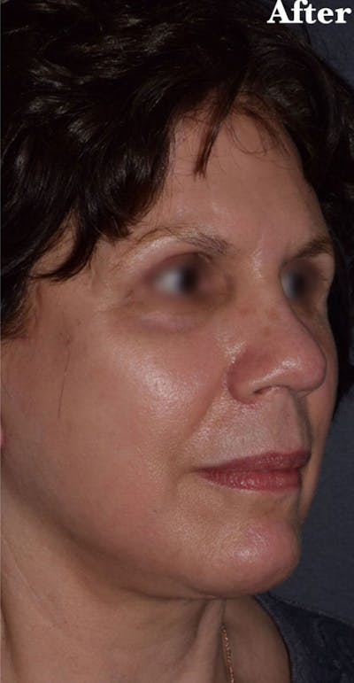 Facelift Before & After Gallery - Patient 175505 - Image 2