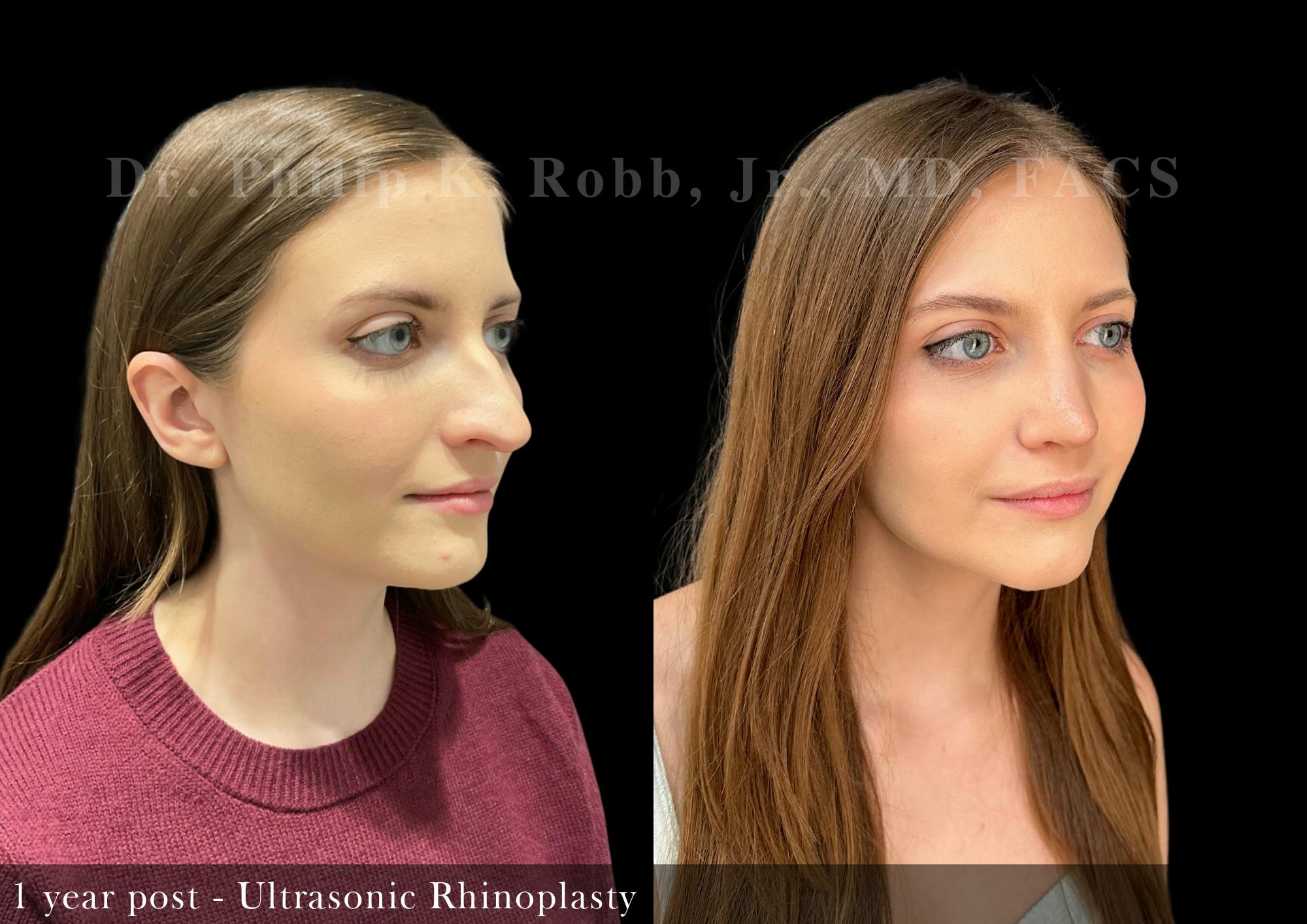 Ultrasonic Rhinoplasty Before & After Gallery - Patient 415896 - Image 2