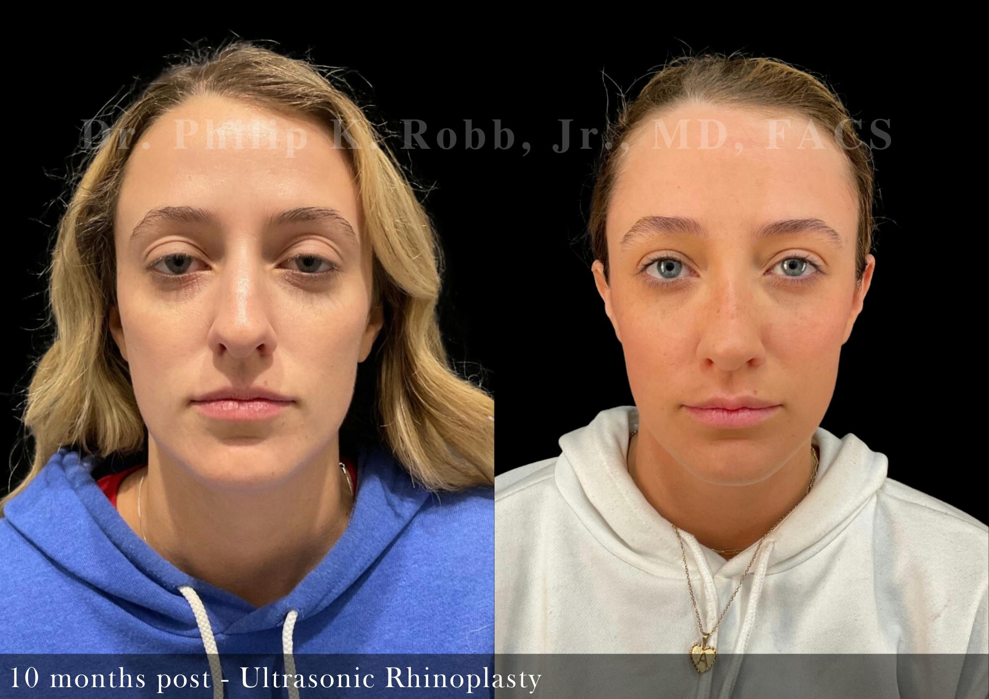 Ultrasonic Rhinoplasty Before & After Gallery - Patient 149562 - Image 3