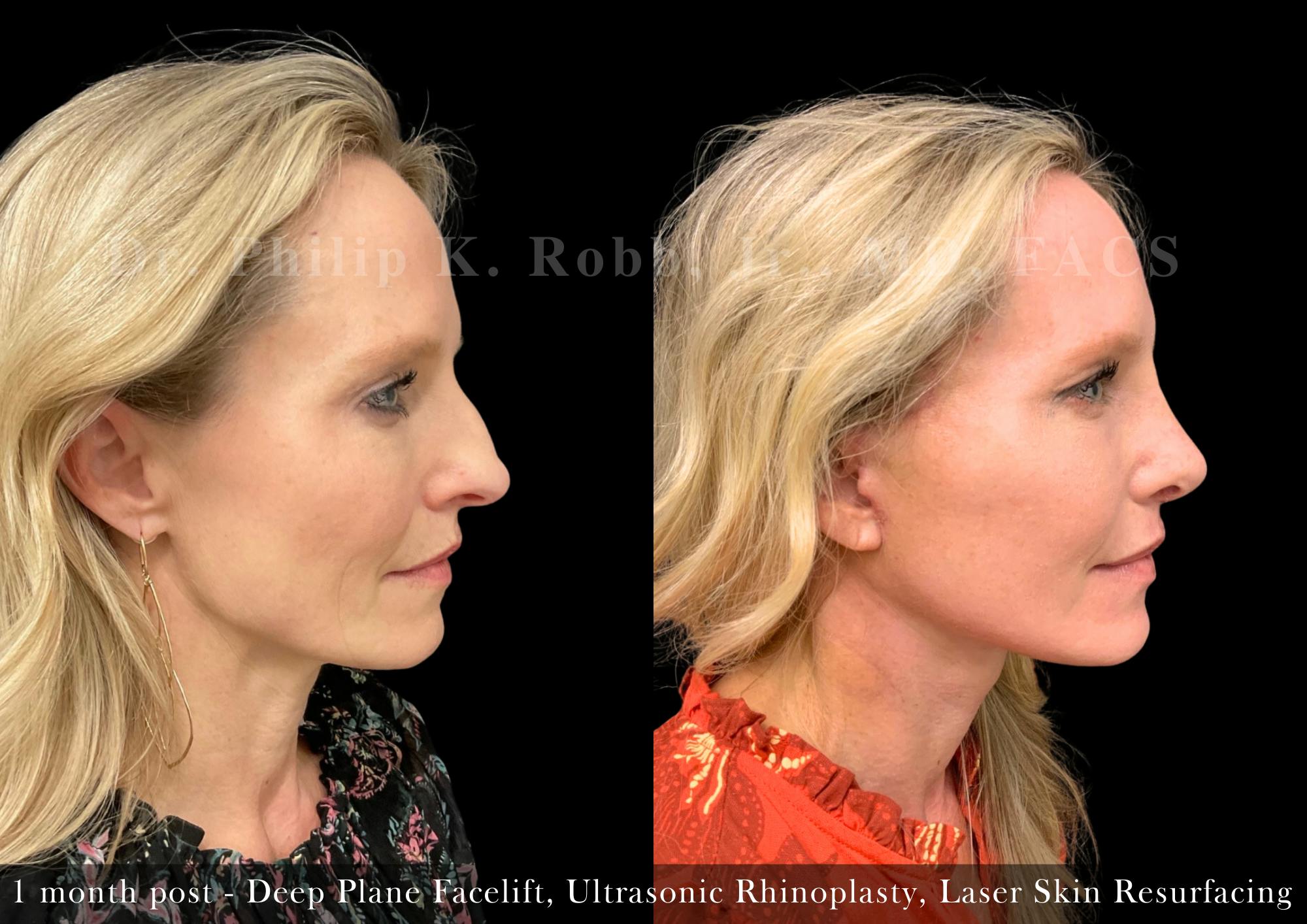 Ultrasonic Rhinoplasty Before & After Gallery - Patient 184349 - Image 1