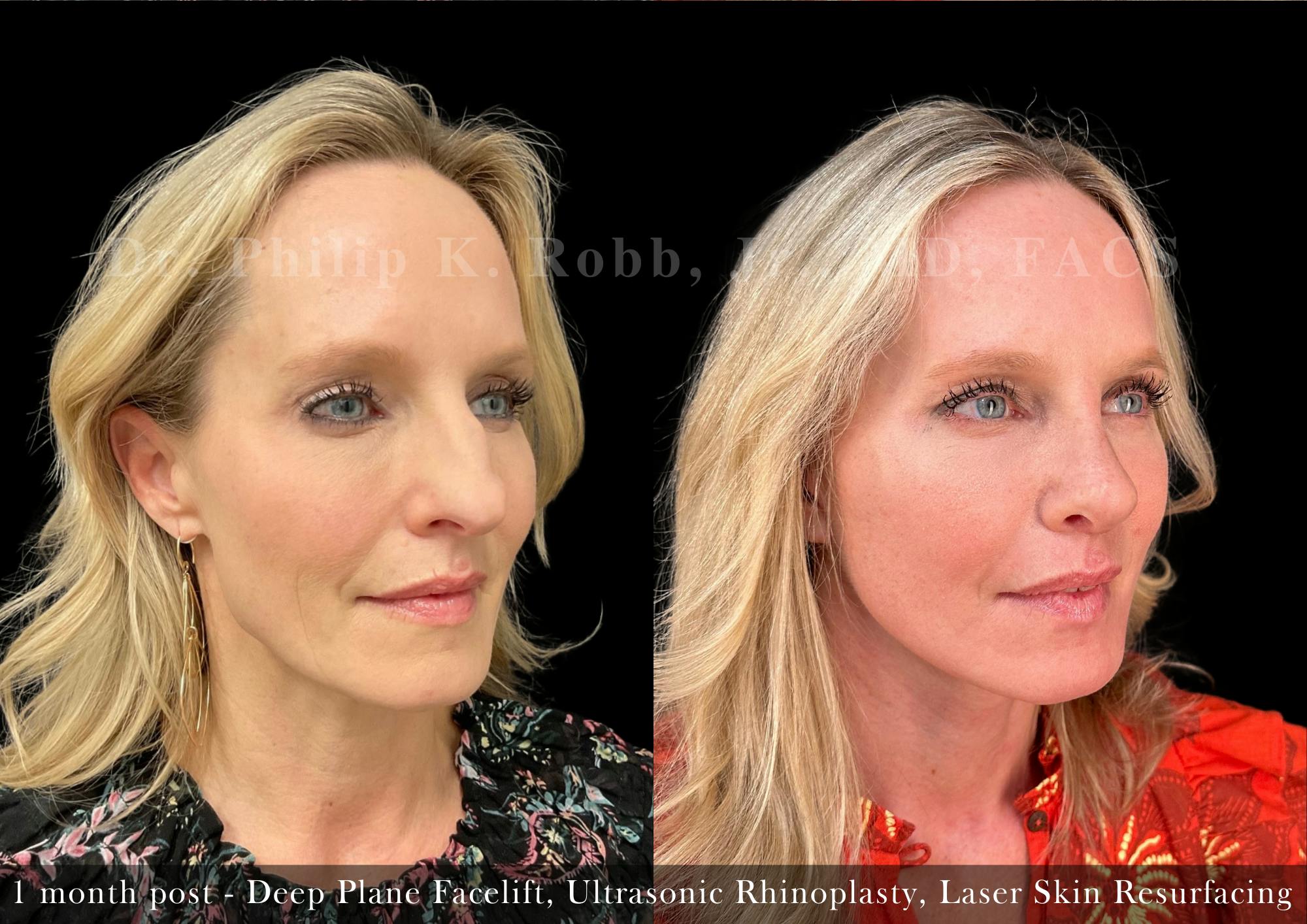 Ultrasonic Rhinoplasty Before & After Gallery - Patient 184349 - Image 2
