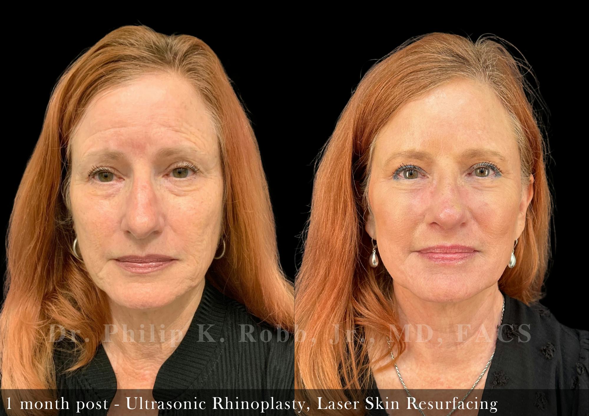 Ultrasonic Rhinoplasty Before & After Gallery - Patient 969488 - Image 3