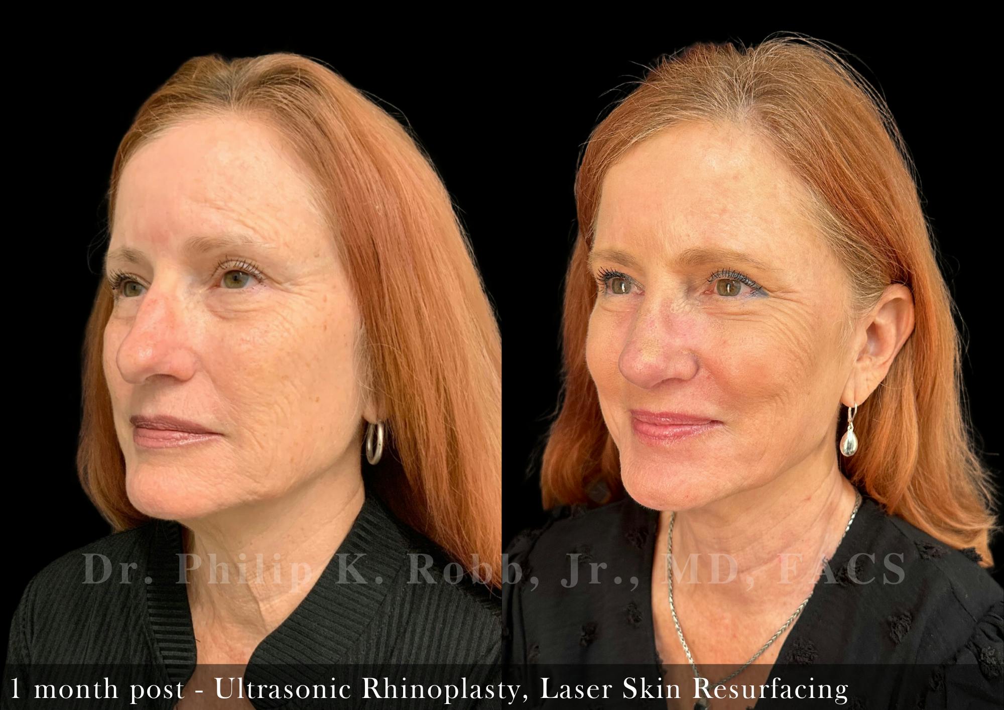 Ultrasonic Rhinoplasty Before & After Gallery - Patient 969488 - Image 4