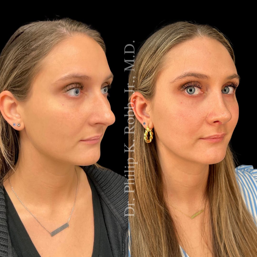 Ultrasonic Rhinoplasty Before & After Gallery - Patient 308788 - Image 3