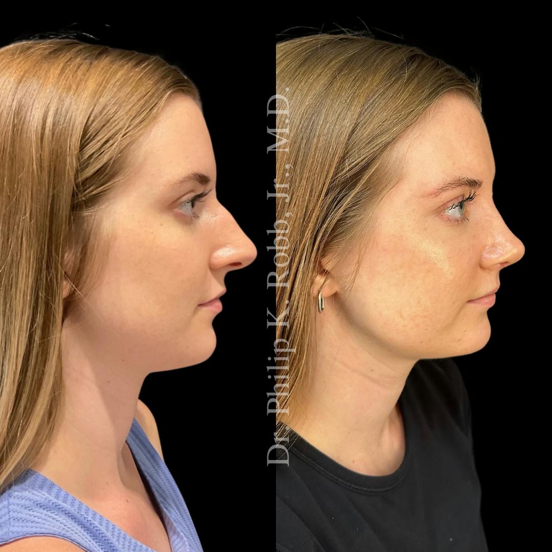 Ultrasonic Rhinoplasty Before & After Gallery - Patient 383178 - Image 1
