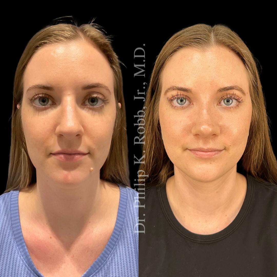 Ultrasonic Rhinoplasty Before & After Gallery - Patient 383178 - Image 2