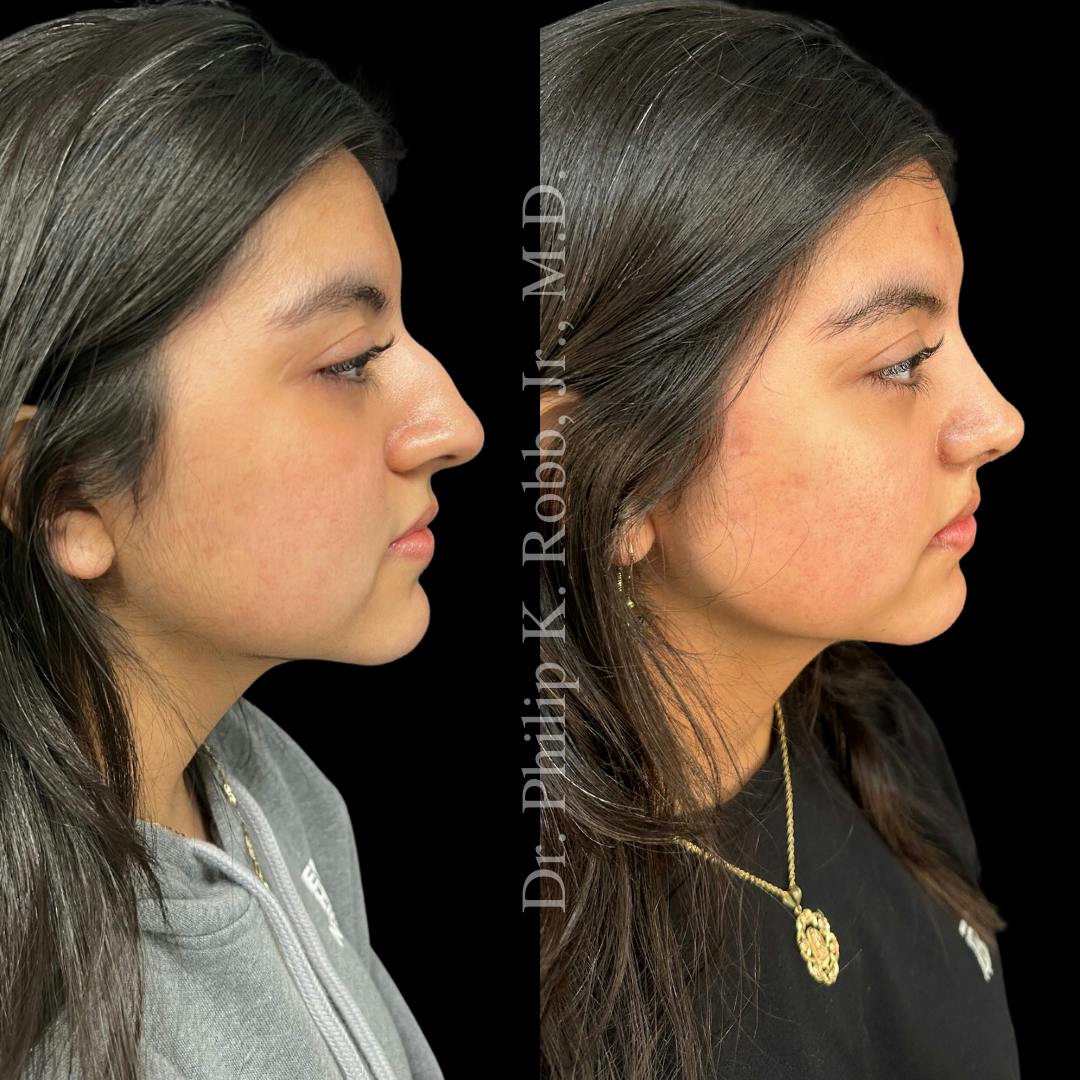 Ultrasonic Rhinoplasty Before & After Gallery - Patient 302915 - Image 1