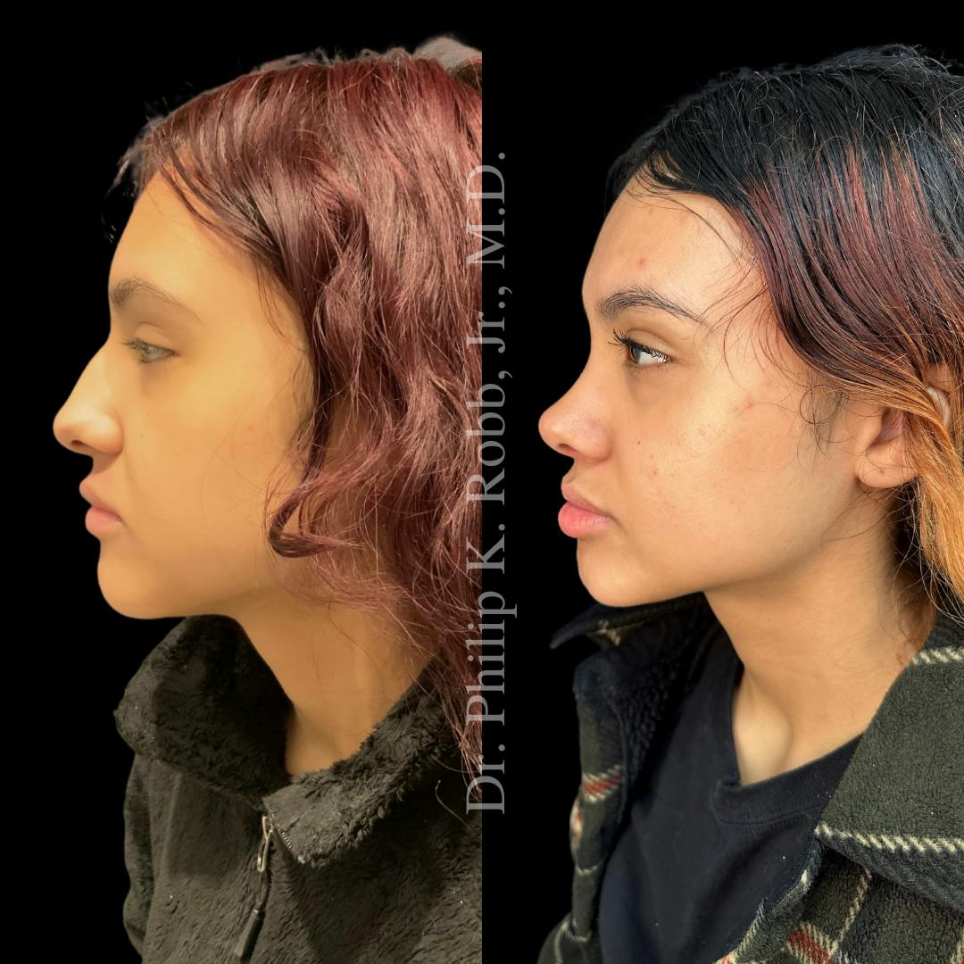 Ultrasonic Rhinoplasty Before & After Gallery - Patient 592725 - Image 5