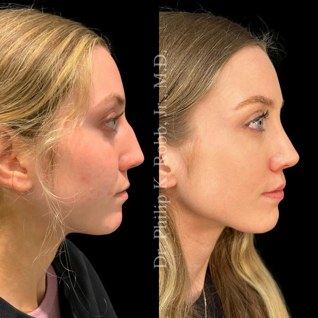 Ultrasonic Rhinoplasty Before & After Gallery - Patient 134352 - Image 1