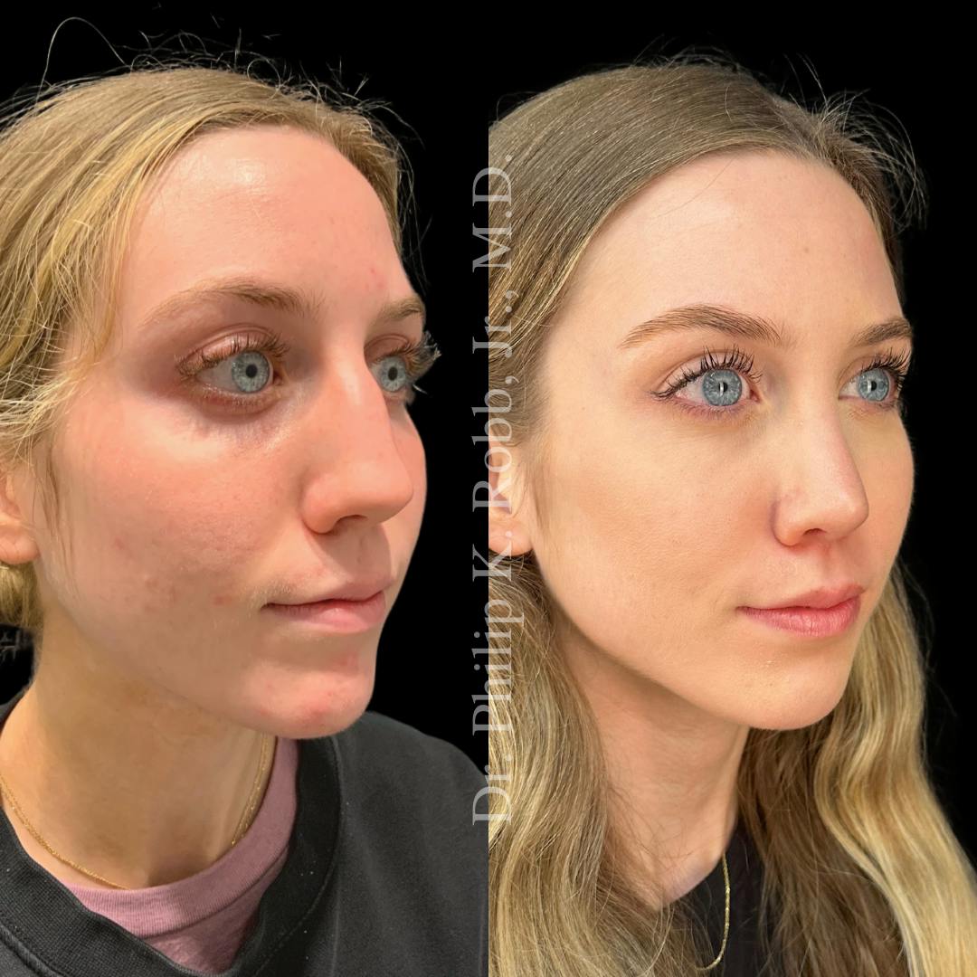 Ultrasonic Rhinoplasty Before & After Gallery - Patient 134352 - Image 5