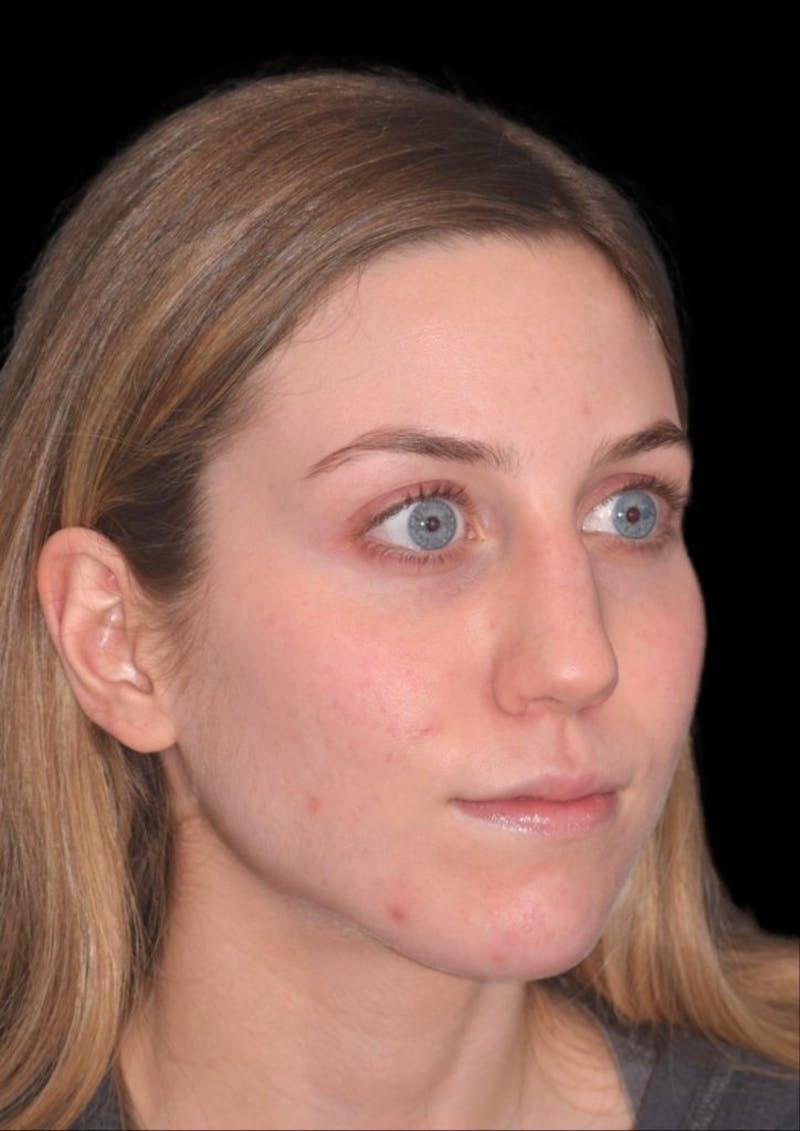 Ultrasonic Rhinoplasty Before & After Gallery - Patient 368751 - Image 5