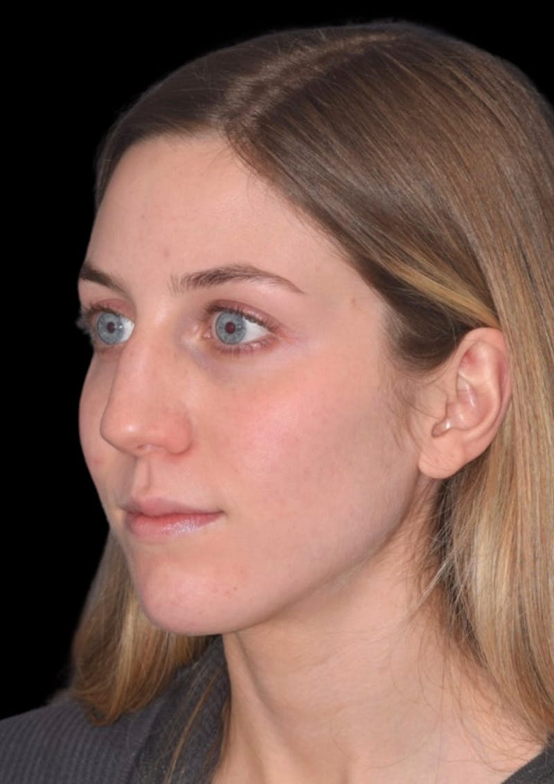 Ultrasonic Rhinoplasty Before & After Gallery - Patient 368751 - Image 7