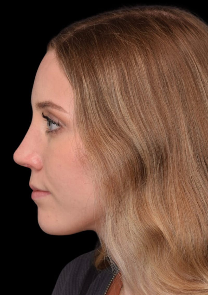 Ultrasonic Rhinoplasty Before & After Gallery - Patient 368751 - Image 10