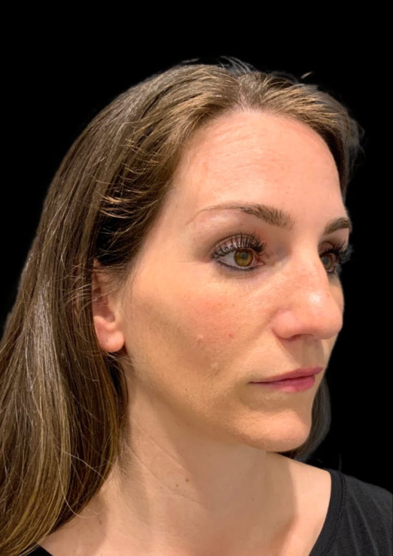 Ultrasonic Rhinoplasty Before & After Gallery - Patient 128856 - Image 5
