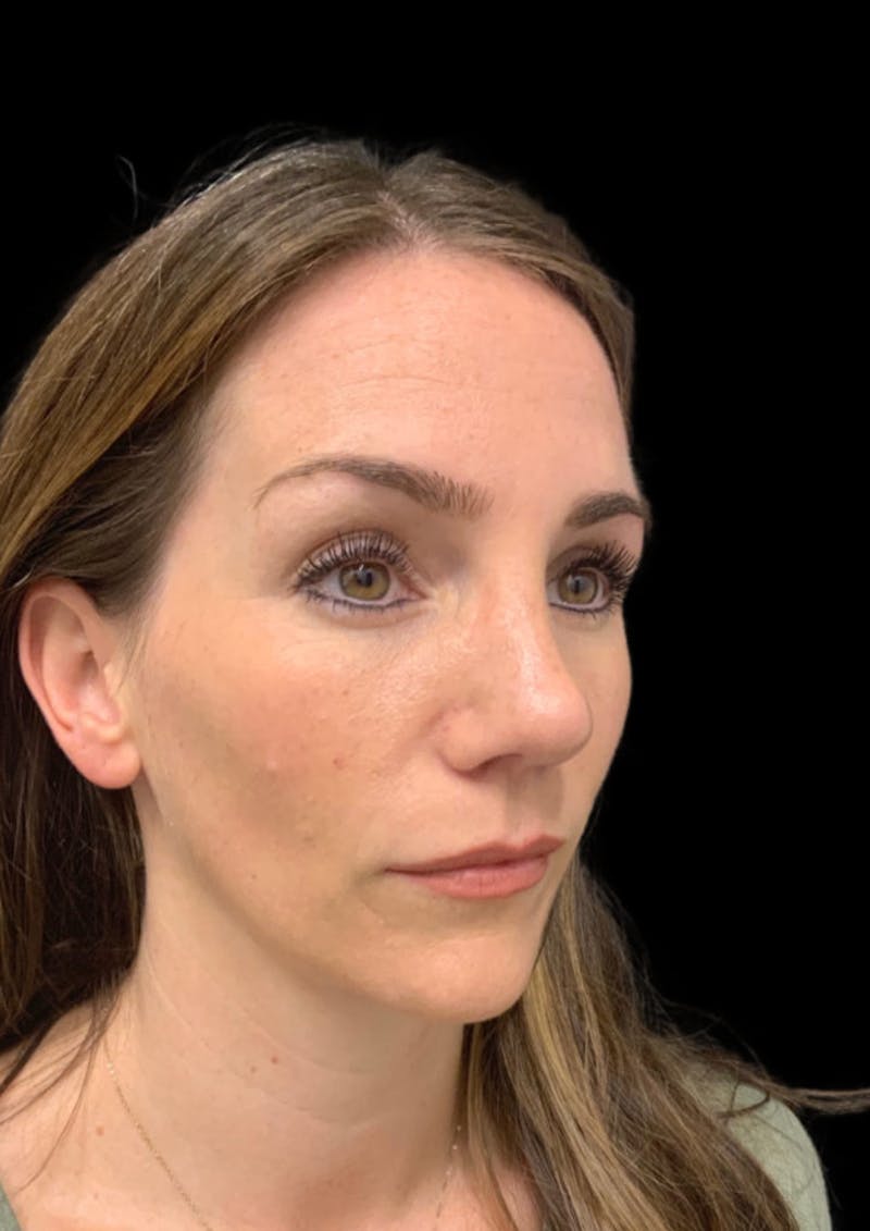 Ultrasonic Rhinoplasty Before & After Gallery - Patient 128856 - Image 6