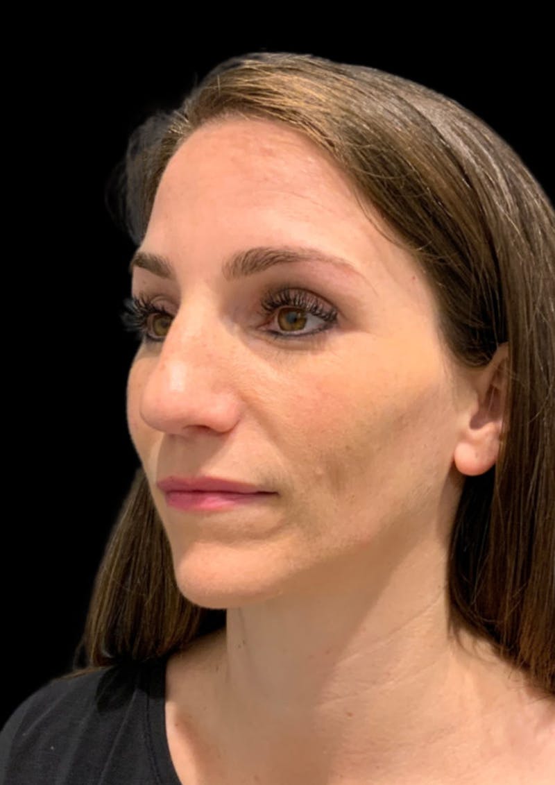 Ultrasonic Rhinoplasty Before & After Gallery - Patient 128856 - Image 7
