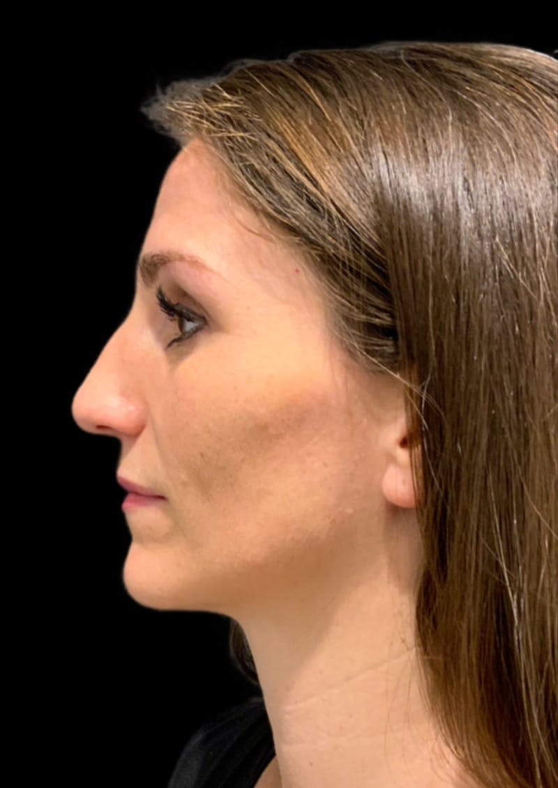 Ultrasonic Rhinoplasty Before & After Gallery - Patient 128856 - Image 9