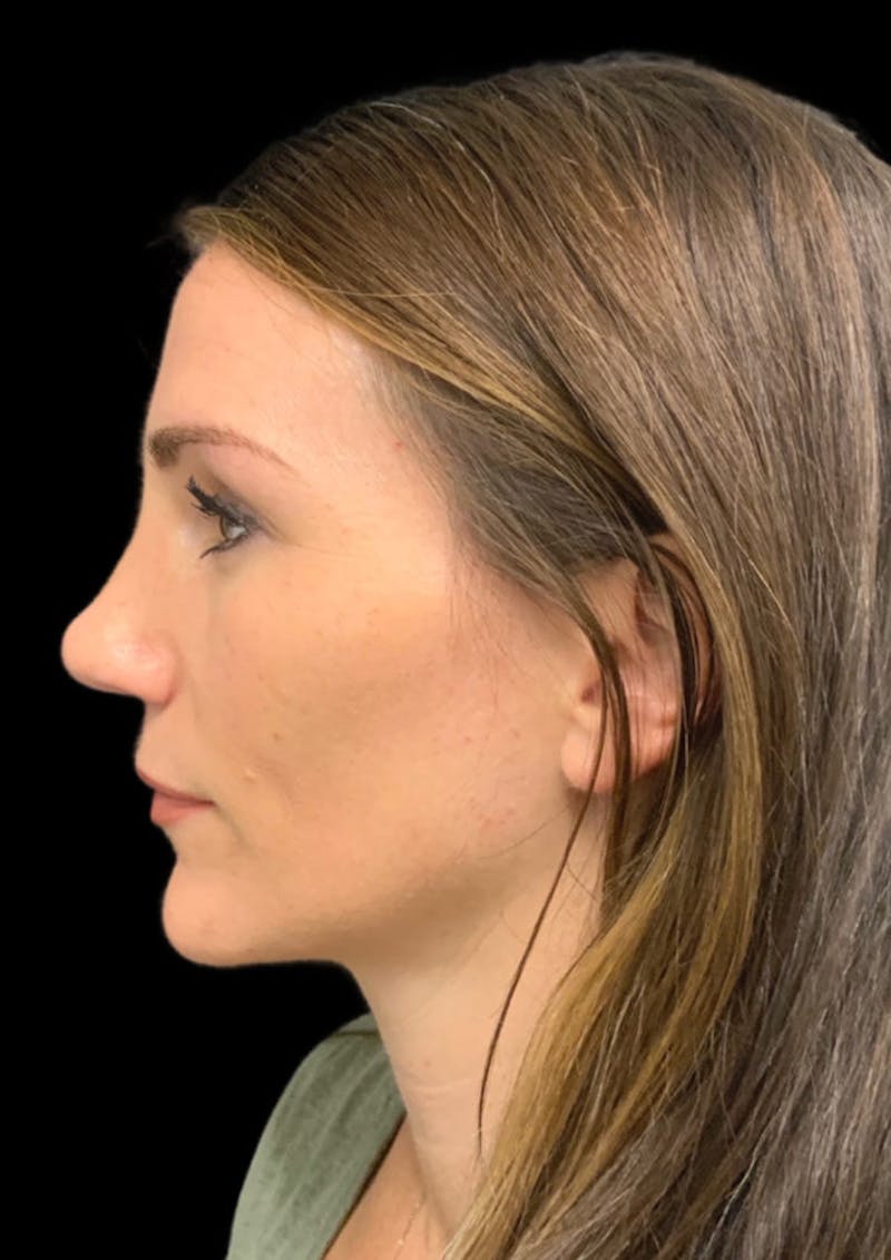 Ultrasonic Rhinoplasty Before & After Gallery - Patient 128856 - Image 10