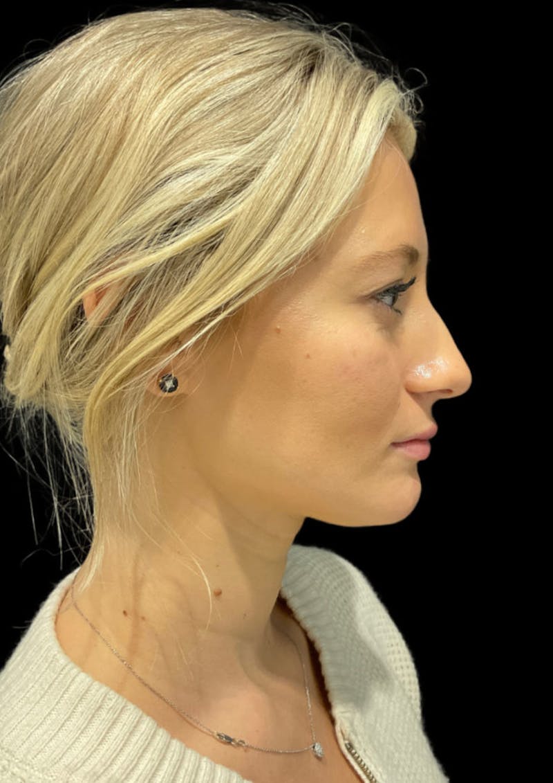 Ultrasonic Rhinoplasty Before & After Gallery - Patient 333782 - Image 1