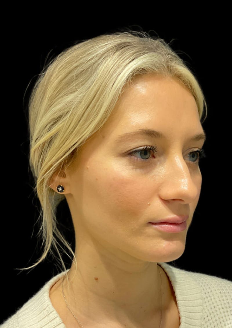Ultrasonic Rhinoplasty Before & After Gallery - Patient 333782 - Image 5