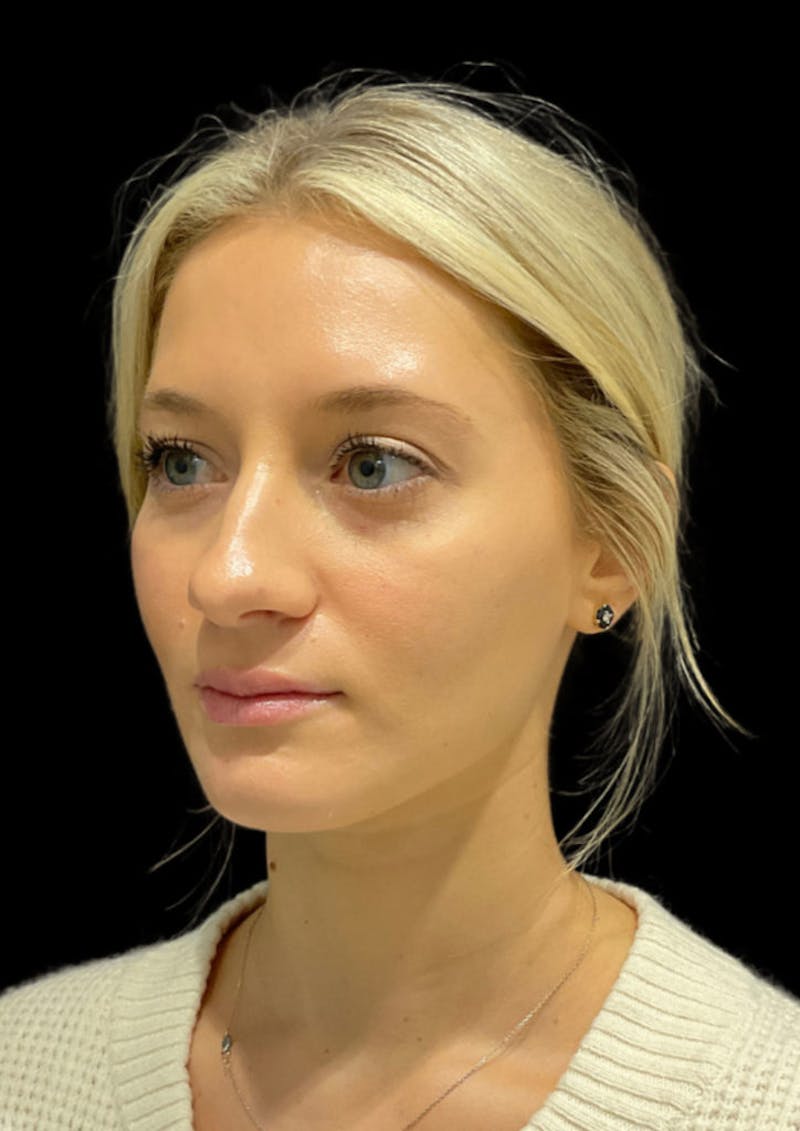 Ultrasonic Rhinoplasty Before & After Gallery - Patient 333782 - Image 7