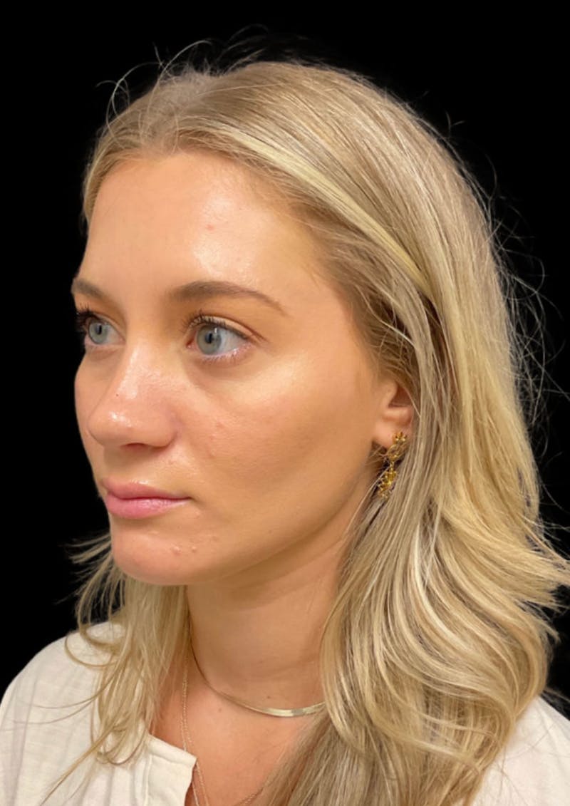 Ultrasonic Rhinoplasty Before & After Gallery - Patient 333782 - Image 8