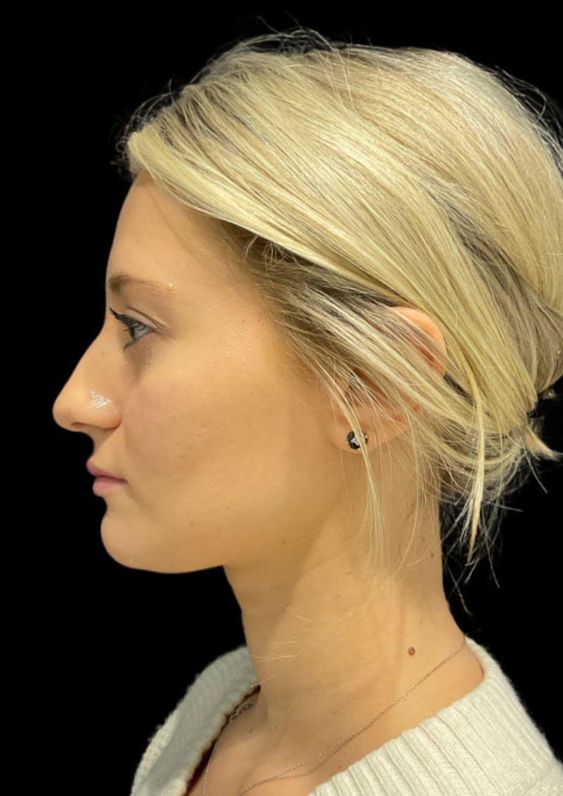 Ultrasonic Rhinoplasty Before & After Gallery - Patient 333782 - Image 9