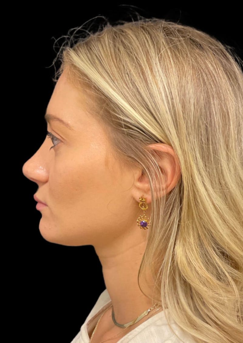 Ultrasonic Rhinoplasty Before & After Gallery - Patient 333782 - Image 10
