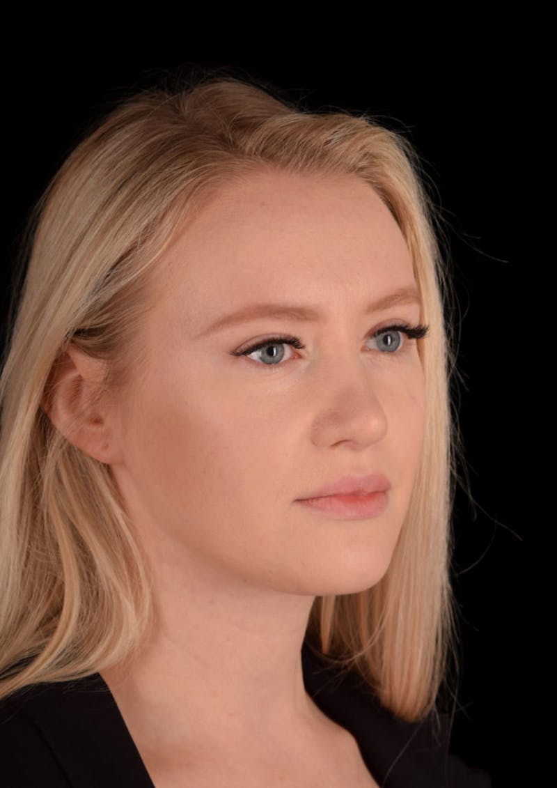 Ultrasonic Rhinoplasty Before & After Gallery - Patient 603544 - Image 6