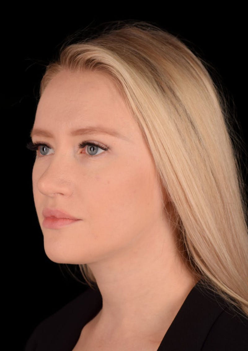 Ultrasonic Rhinoplasty Before & After Gallery - Patient 603544 - Image 8