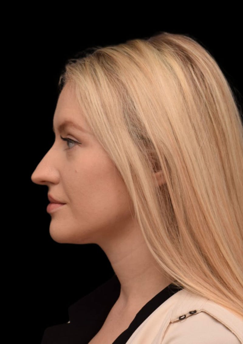 Ultrasonic Rhinoplasty Before & After Gallery - Patient 603544 - Image 9