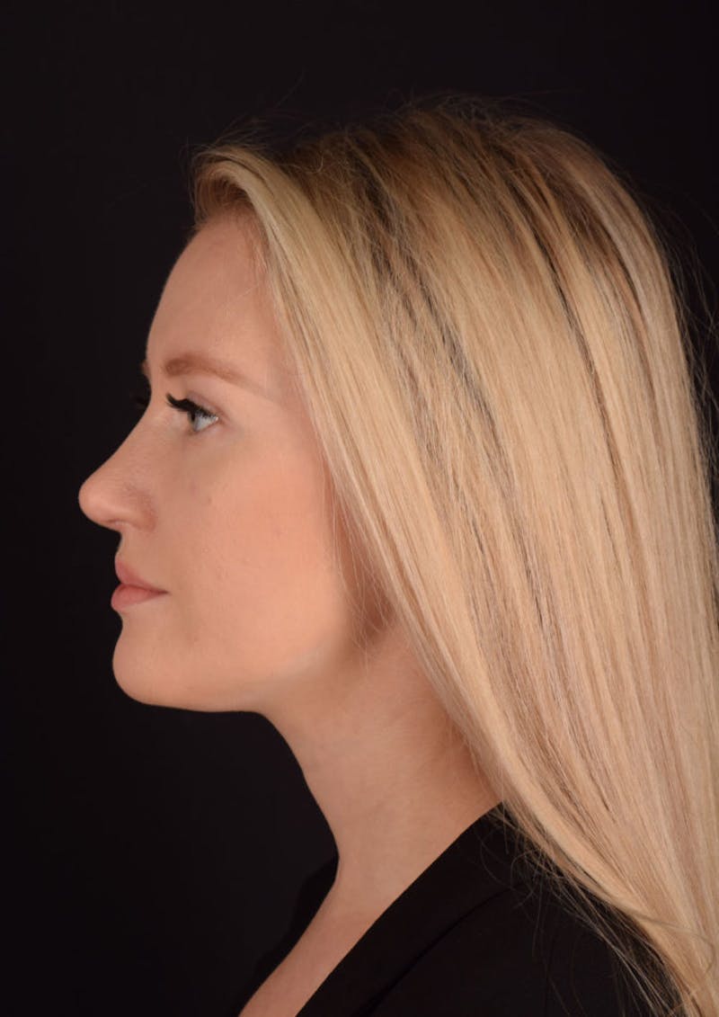 Ultrasonic Rhinoplasty Before & After Gallery - Patient 603544 - Image 10